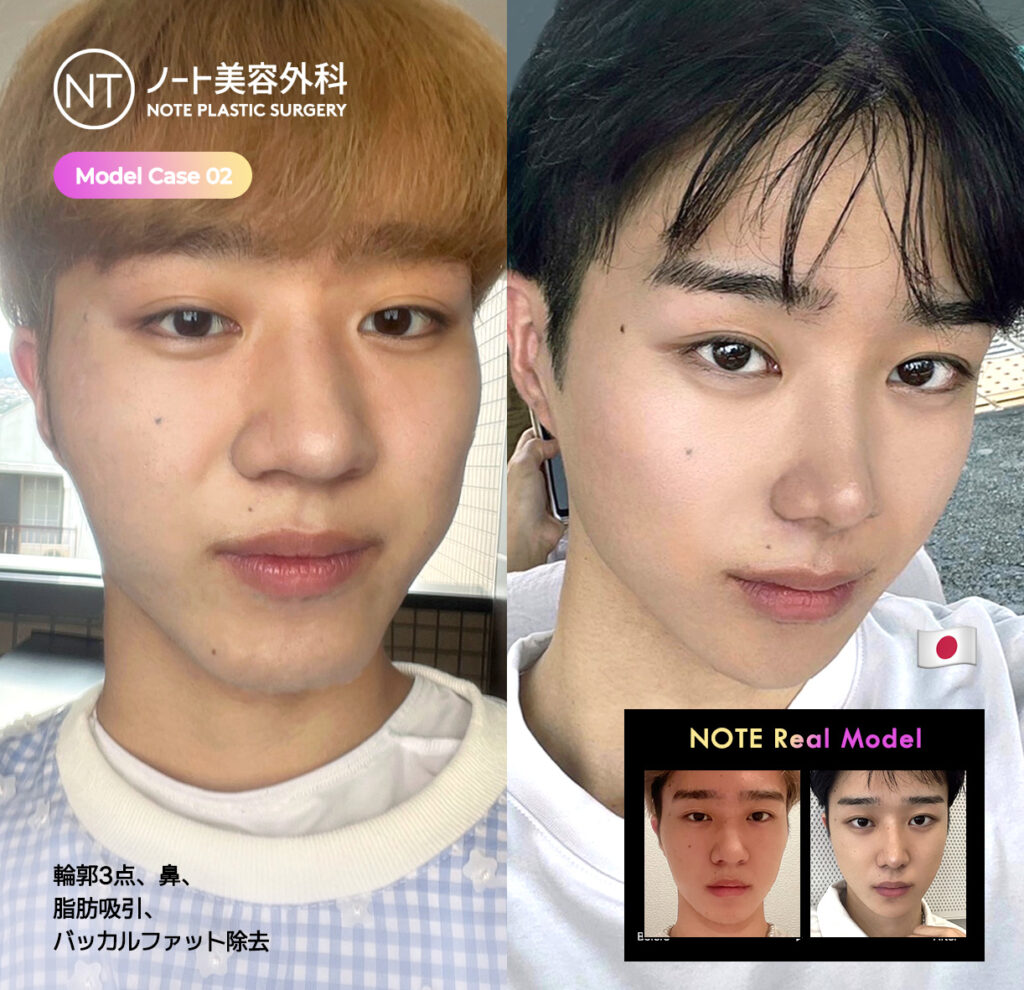 노트성형외과 전후사진 배너2
