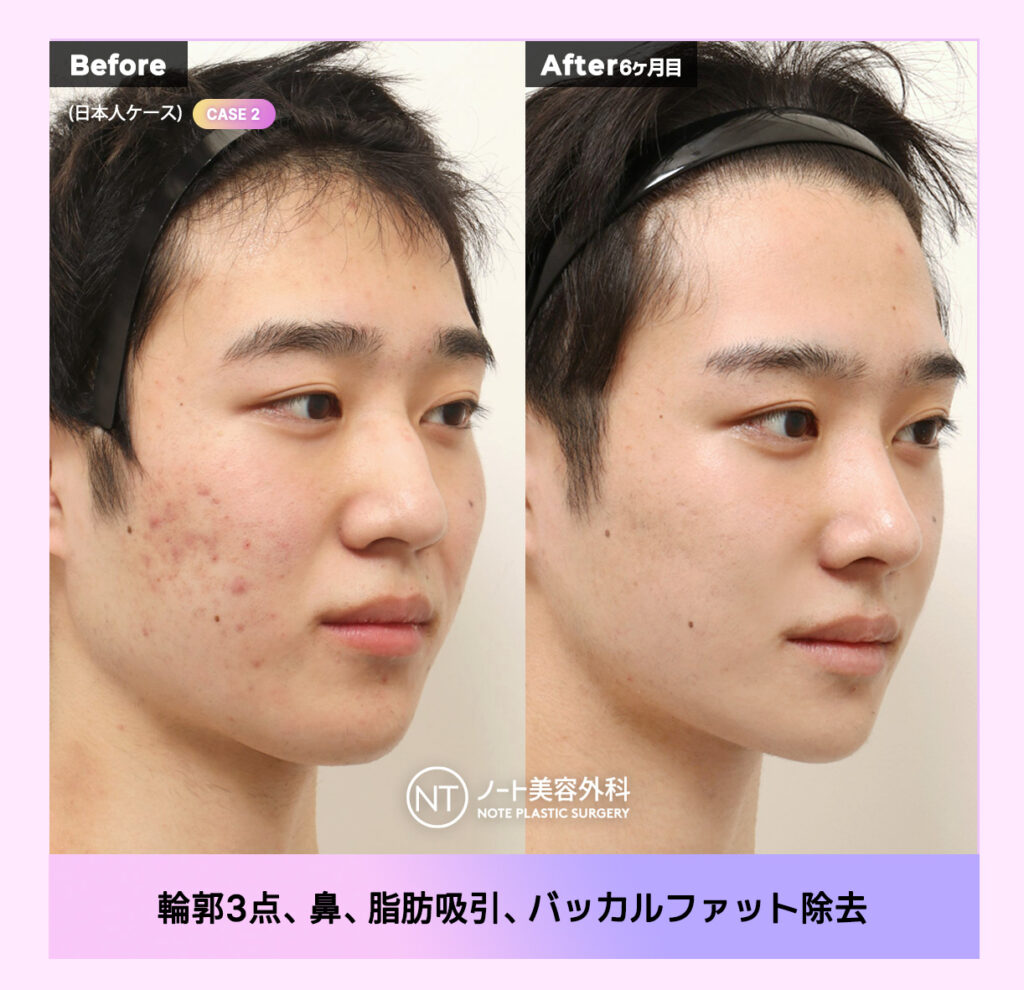 노트성형외과 전후사진 배너4